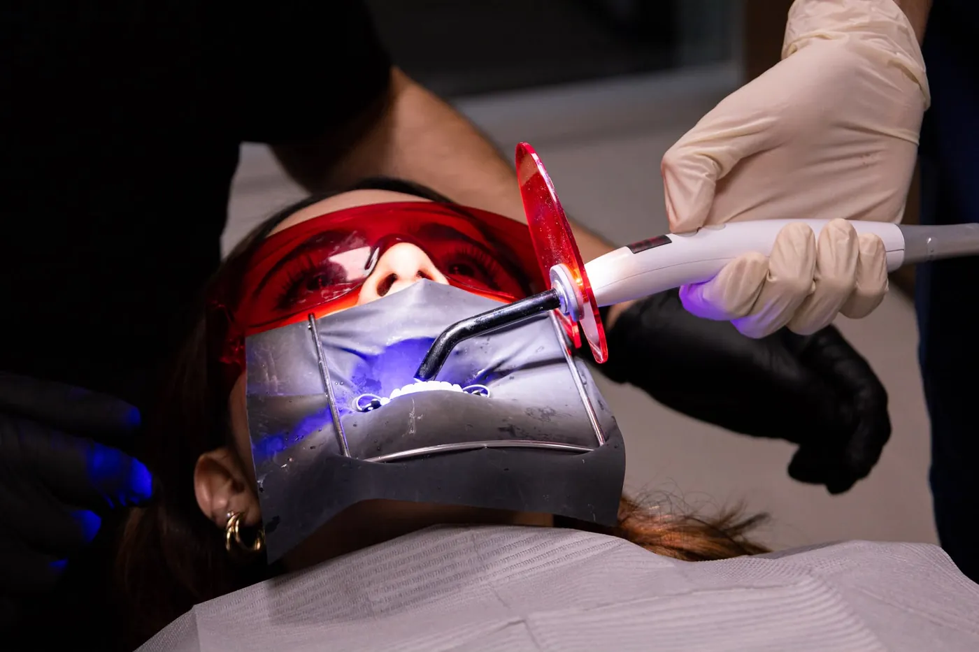 Restauración estética dental con resina